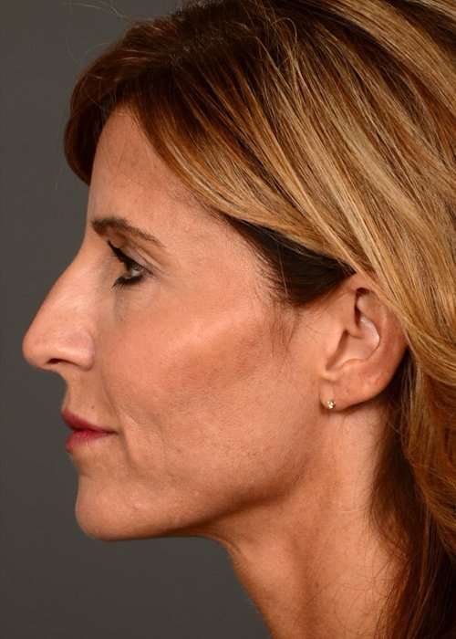 after female non-surgical liquid facelift left side