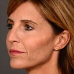 after female non-surgical liquid facelift left facing angle