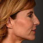 after female non-surgical liquid facelift right side