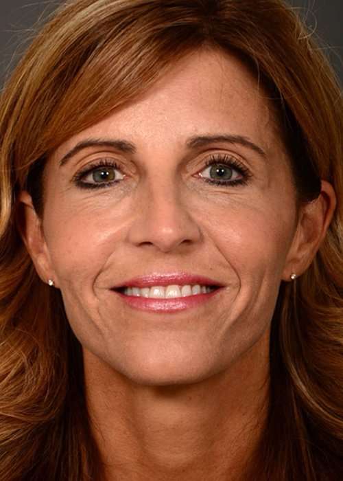 after female non-surgical liquid facelift front