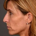 before female non-surgical liquid facelift left side
