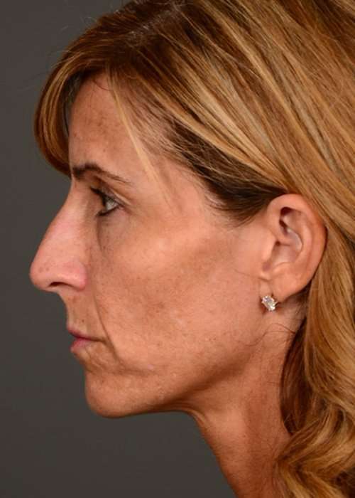 before female non-surgical liquid facelift left side