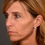 before female non-surgical liquid facelift left facing angle