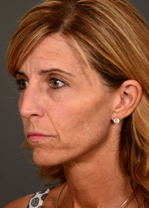 before female non-surgical liquid facelift left facing angle