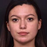 Lip filler Atlanta