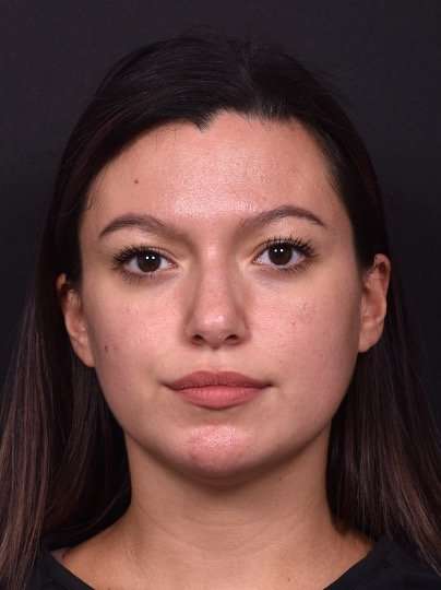 Lip filler Atlanta