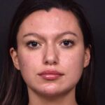 Lip filler Atlanta