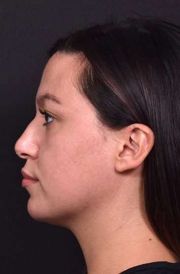 Lip filler Atlanta