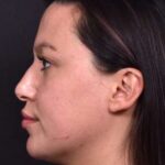 Lip filler Atlanta