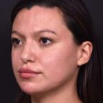Lip filler Atlanta