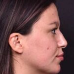 Lip filler Atlanta