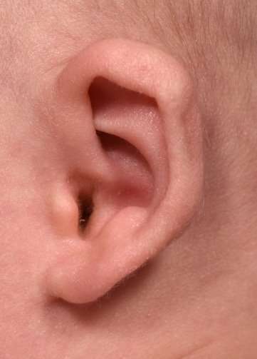 Earwell newborn baby ear correction