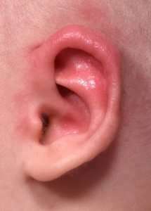 Earwell newborn baby ear correction