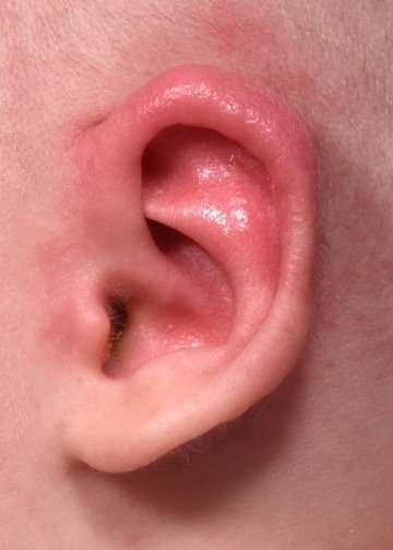 Earwell newborn baby ear correction