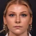 Chin filler contouring