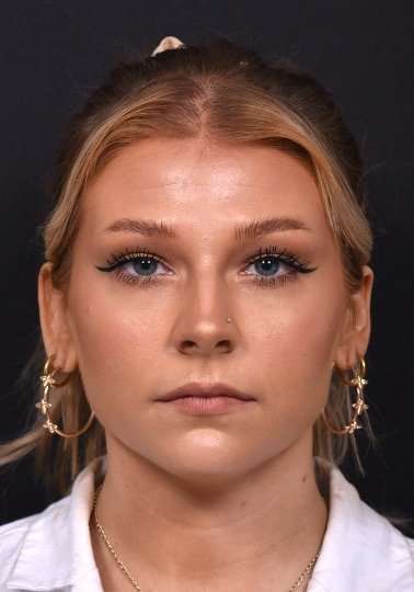 Chin filler contouring