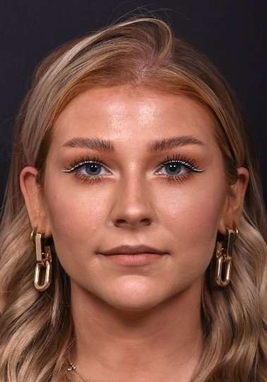 Chin filler contouring