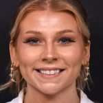 Chin filler contouring