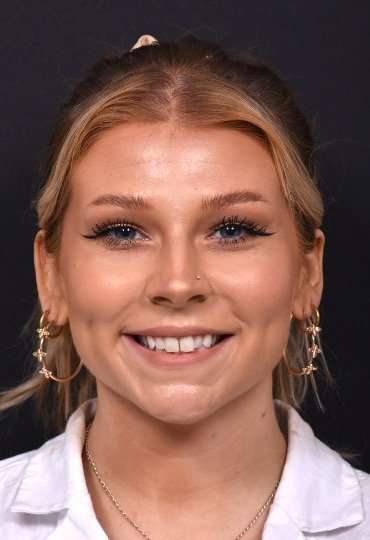 Chin filler contouring