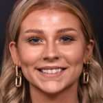 Chin filler contouring