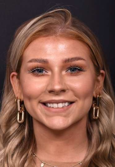 Chin filler contouring