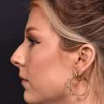 Chin filler contouring