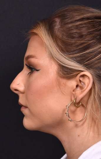 Chin filler contouring