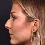 Chin filler contouring