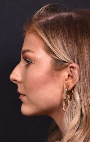 Chin filler contouring