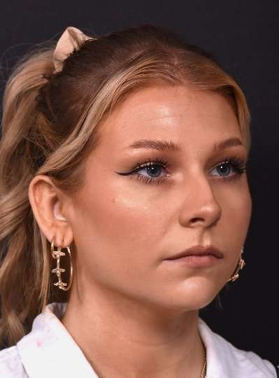 Chin jawline filler contouring