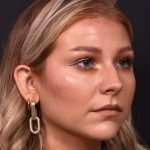 Chin jawline filler contouring