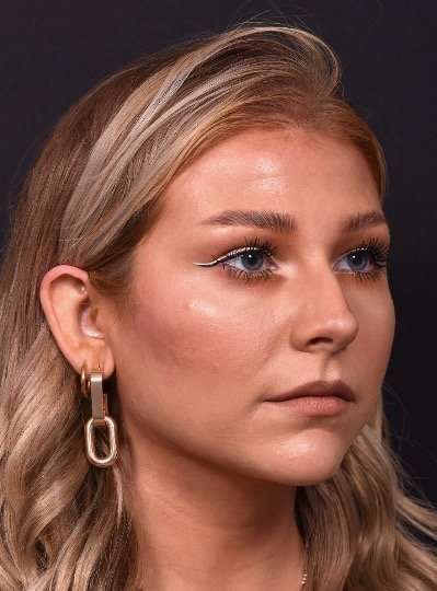 Chin jawline filler contouring