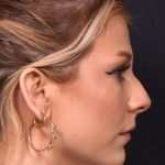 Chin jawline filler contouring