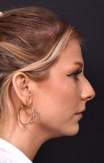 Chin jawline filler contouring