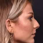 Chin jawline filler contouring