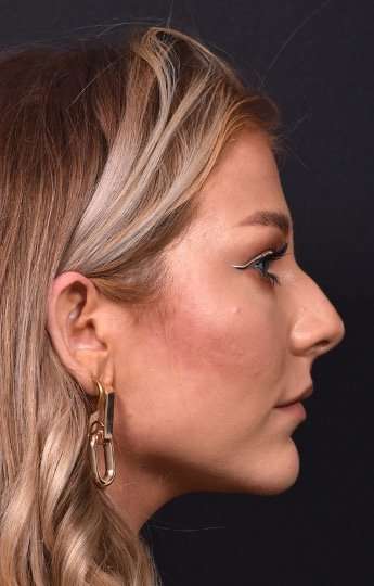 Chin jawline filler contouring