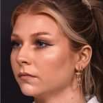 Chin jawline filler contouring