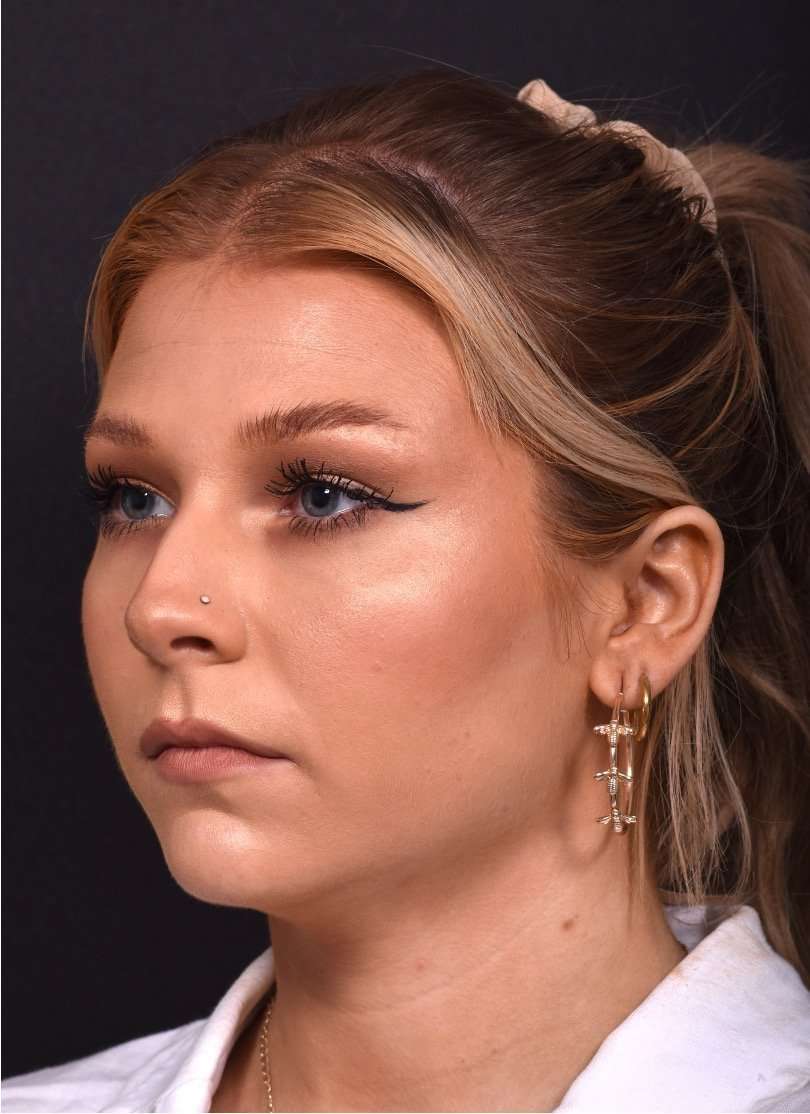 Chin jawline filler contouring