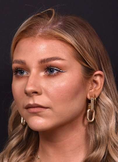 Chin jawline filler contouring