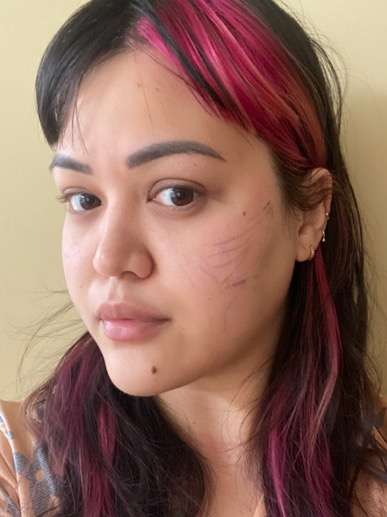Buccal fat reduction