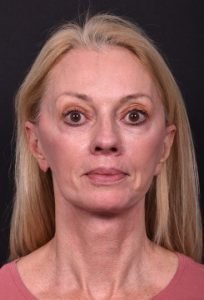 Facelift and necklift