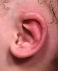 Earwell baby ear correction