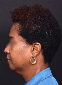 Neck lift and chin implant