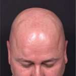 Lipoma forehead bump surgery