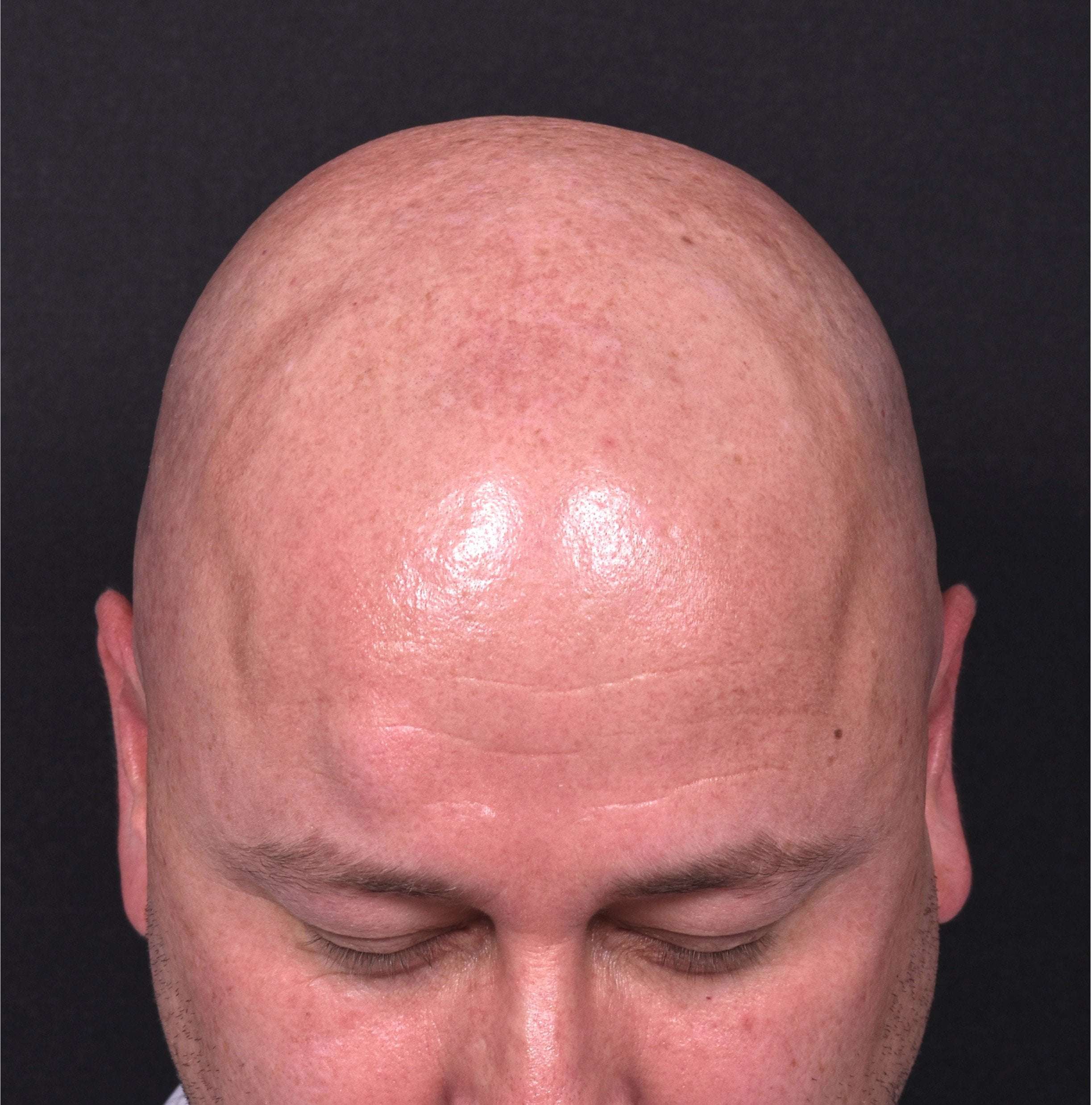 Lipoma forehead bump surgery