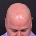 Lipoma forehead bump surgery