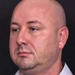 Lipoma surgery bump forehead Atlanta after