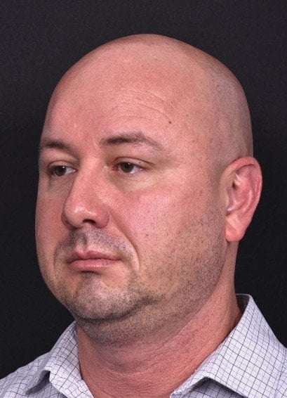 Lipoma surgery bump forehead Atlanta after