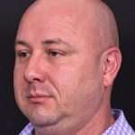 Lipoma surgery bump forehead Atlanta after