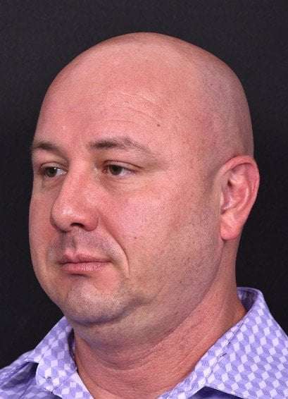 Lipoma surgery bump forehead Atlanta after